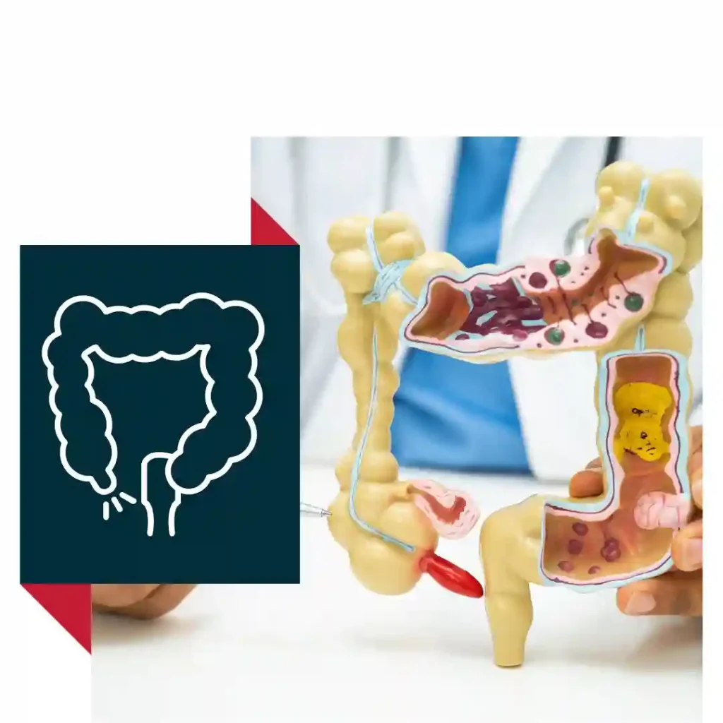 Emergency and planned surgeries for appendicitis. Minimally invasive laparoscopic appendectomy offered. Fast recovery with minimal hospital stay. Extended Explanation: Acute appendicitis is a medical emergency. Dr. Amit provides prompt surgical care to prevent complications like rupture or infection. The laparoscopic technique ensures smaller cuts and quicker return to normal life.