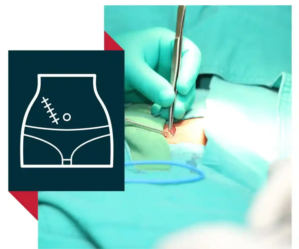 Hernia Treatment & Repair