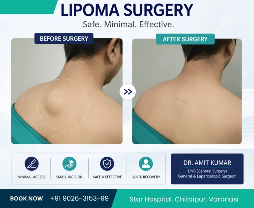 Lipoma Removal Surgery in Varanasi Dr Amit Kumar Star Hospital Lipoma Removal Cost Best Surgeon